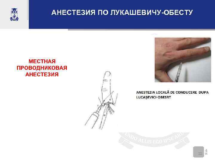 АНЕСТЕЗИЯ ПО ЛУКАШЕВИЧУ-ОБЕСТУ МЕСТНАЯ ПРОВОДНИКОВАЯ АНЕСТЕЗИЯ ПО ЛУКАШЕВИЧУОБЕСТУ 22 