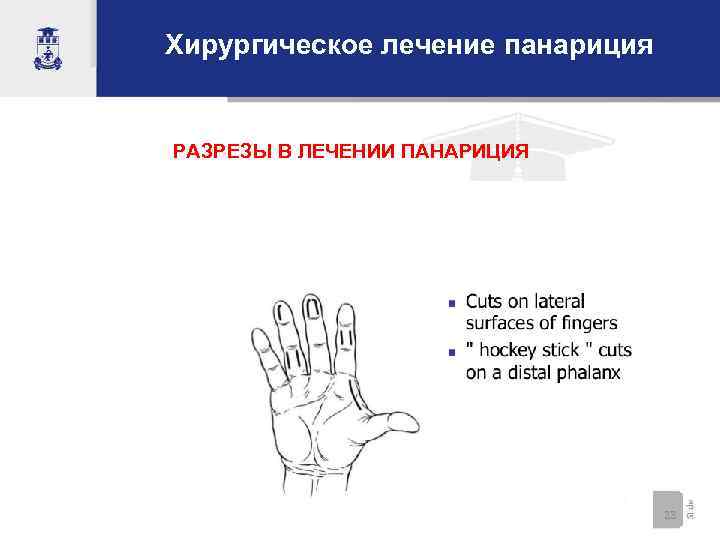 Хирургическое лечение панариция РАЗРЕЗЫ В ЛЕЧЕНИИ ПАНАРИЦИЯ 23 