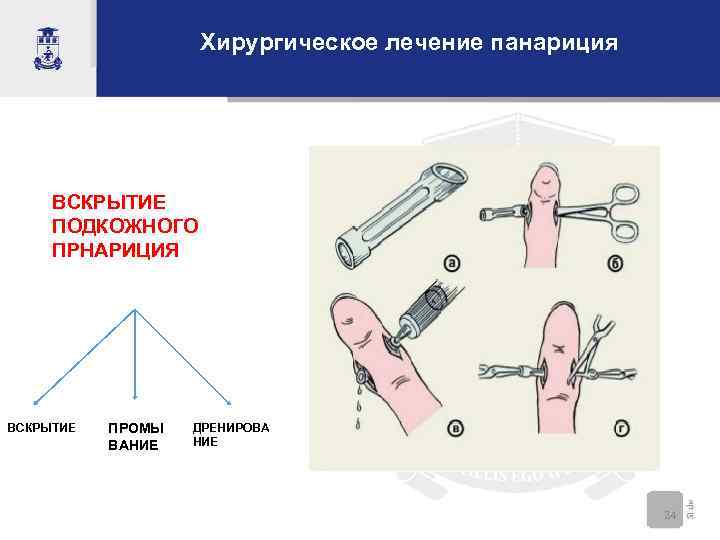 Хирургическое лечение панариция ВСКРЫТИЕ ПОДКОЖНОГО ПРНАРИЦИЯ ВСКРЫТИЕ ПРОМЫ ВАНИЕ ДРЕНИРОВА НИЕ 24 