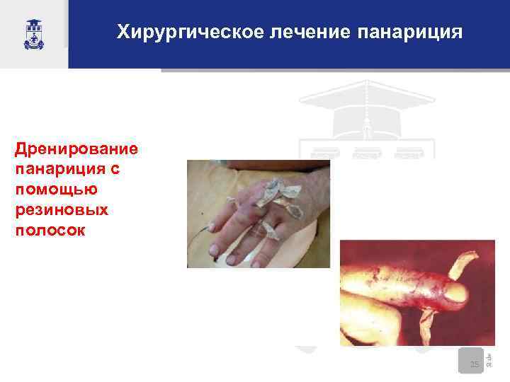 Хирургическое лечение панариция Дренирование панариция с помощью резиновых полосок 25 
