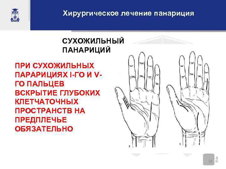Хирургическое лечение панариция СУХОЖИЛЬНЫЙ ПАНАРИЦИЙ ПРИ СУХОЖИЛЬНЫХ ПАРАРИЦИЯХ l-ГО И VГО ПАЛЬЦЕВ ВСКРЫТИЕ ГЛУБОКИХ