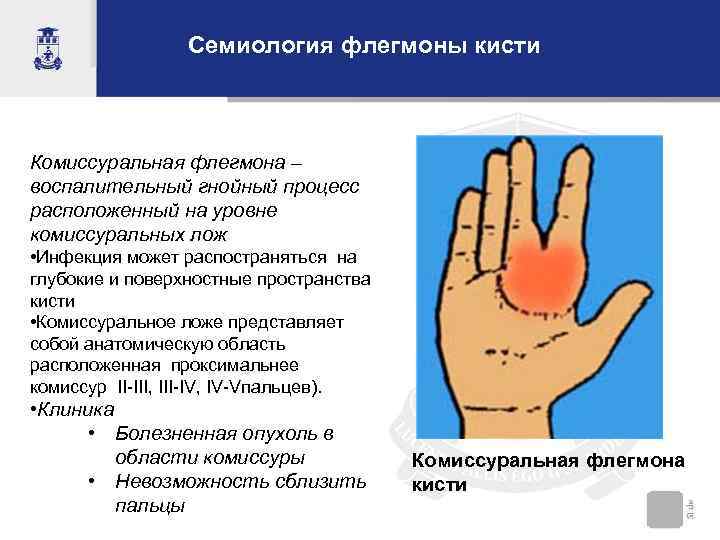 Семиология флегмоны кисти Комиссуральная флегмона – воспалительный гнойный процесс расположенный на уровне комиссуральных лож