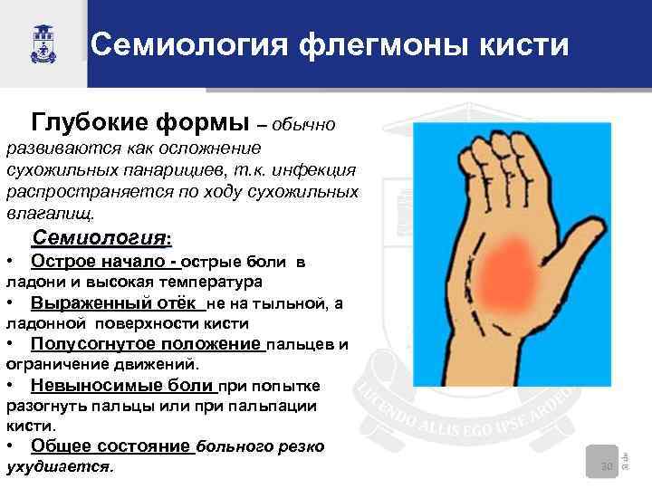 Семиология флегмоны кисти Глубокие формы – обычно развиваются как осложнение сухожильных панарициев, т. к.