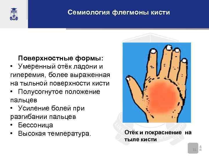 Семиология флегмоны кисти Поверхностные формы: • Умеренный отёк ладони и гиперемия, более выраженная на