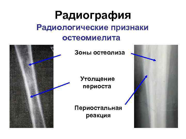 Радиография Радиологические признаки остеомиелита Зоны остеолиза Утолщение периоста Периостальная реакция 
