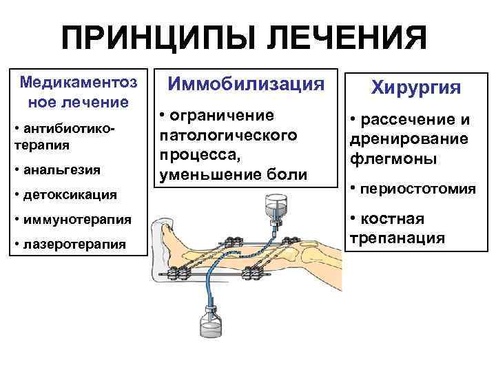 ПРИНЦИПЫ ЛЕЧЕНИЯ Медикаментоз ное лечение • антибиотикотерапия • анальгезия • детоксикация • иммунотерапия •