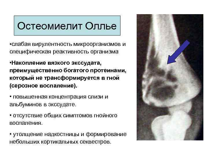 Огнестрельный остеомиелит