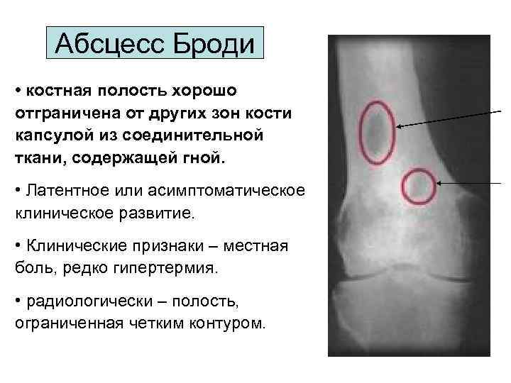 Абсцесс Броди • костная полость хорошо отграничена от других зон кости капсулой из соединительной