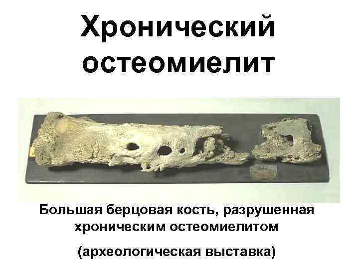 Хронический остеомиелит Большая берцовая кость, разрушенная хроническим остеомиелитом (археологическая выставка) 