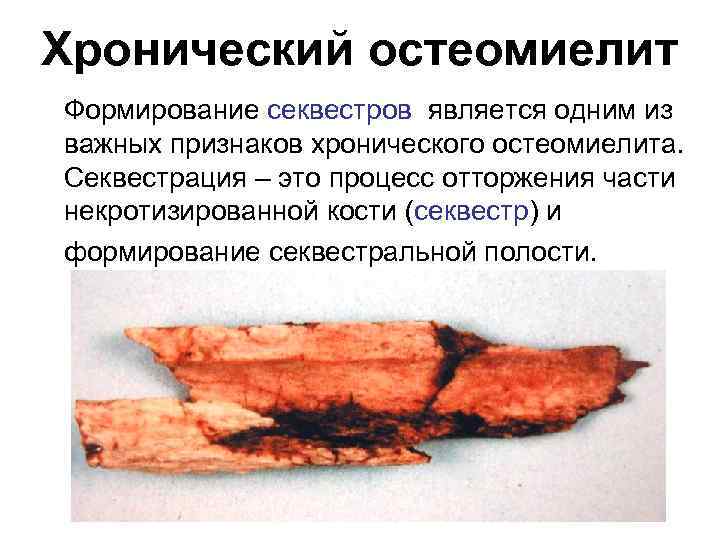 Хронический остеомиелит Формирование секвестров является одним из важных признаков хронического остеомиелита. Секвестрация – это