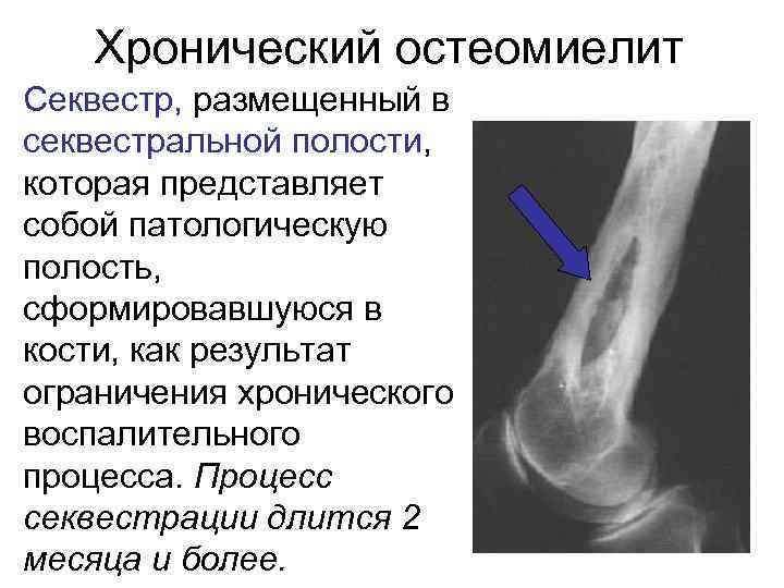 Хронический остеомиелит Секвестр, размещенный в секвестральной полости, которая представляет собой патологическую полость, сформировавшуюся в