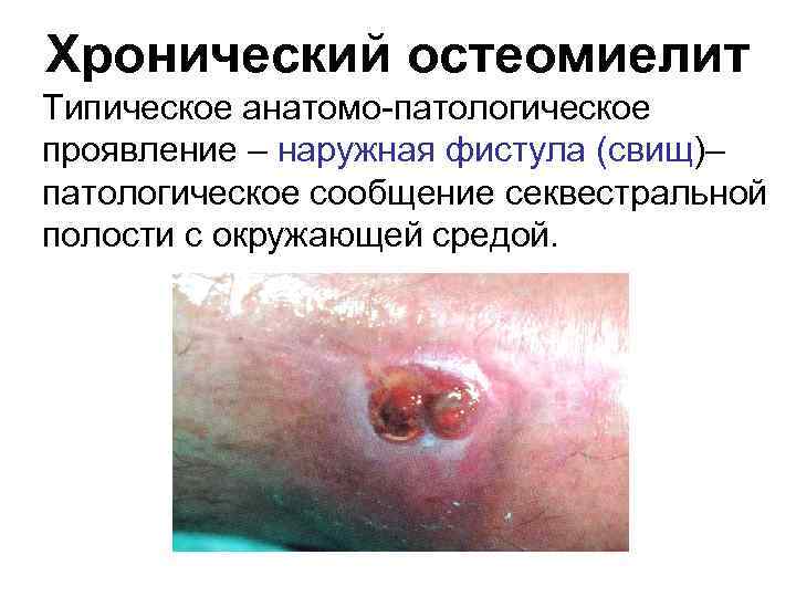 Хронический остеомиелит Типическое анатомо-патологическое проявление – наружная фистула (свищ)– патологическое сообщение секвестральной полости с