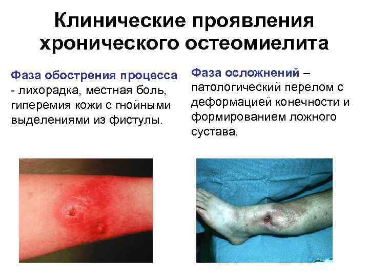Клинические проявления хронического остеомиелита Фаза обострения процесса - лихорадка, местная боль, гиперемия кожи с