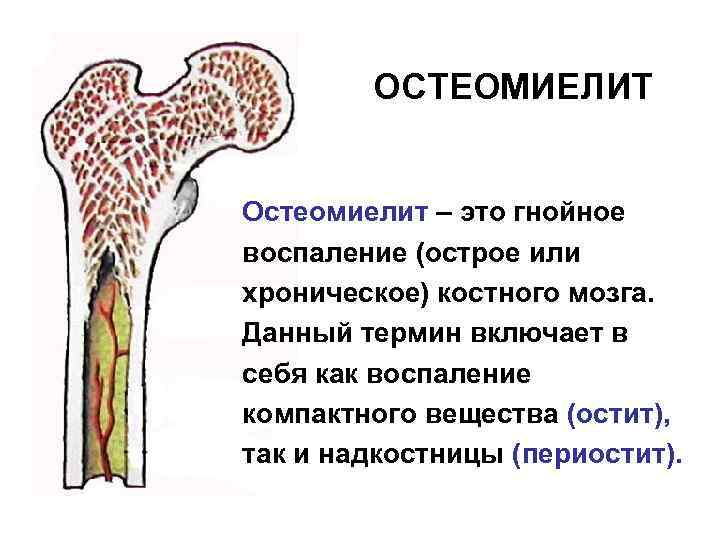 ОСТЕОМИЕЛИТ Остеомиелит – это гнойное воспаление (острое или хроническое) костного мозга. Данный термин включает