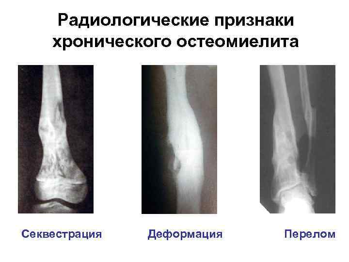 Радиологические признаки хронического остеомиелита Секвестрация Деформация Перелом 