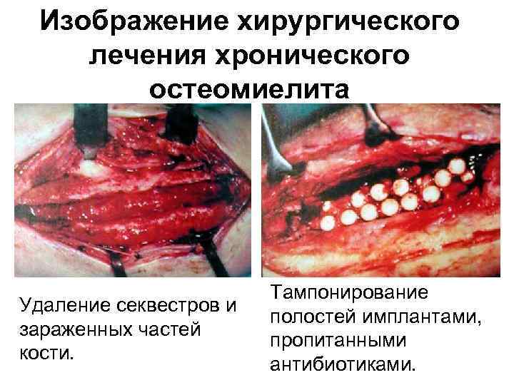 Изображение хирургического лечения хронического остеомиелита Удаление секвестров и зараженных частей кости. Тампонирование полостей имплантами,