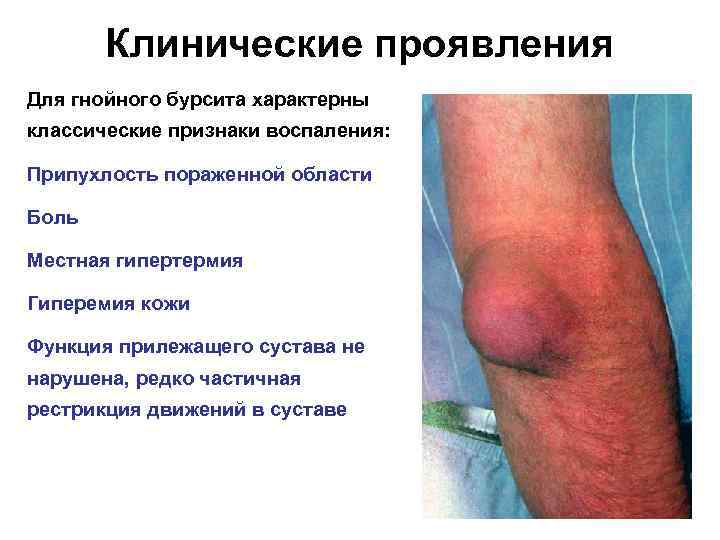 Клинические проявления Для гнойного бурсита характерны классические признаки воспаления: Припухлость пораженной области Боль Местная