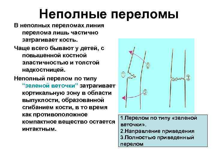 Неполные переломы В неполных переломах линия перелома лишь частично затрагивает кость. Чаще всего бывают