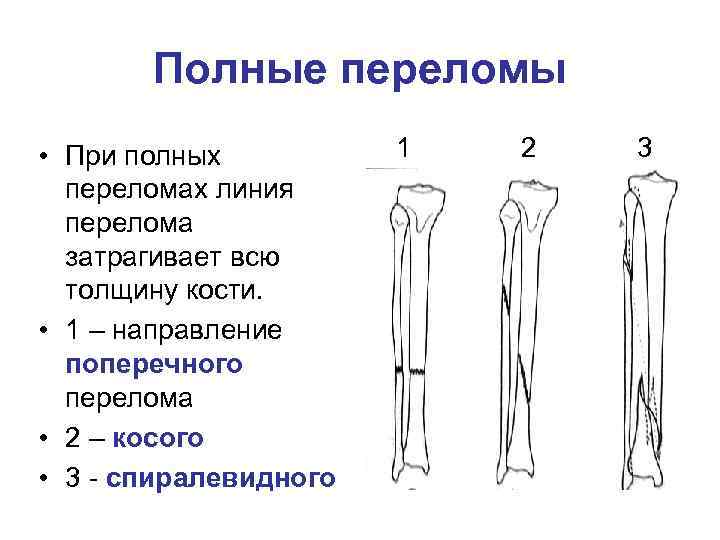 Полные переломы • При полных переломах линия перелома затрагивает всю толщину кости. • 1