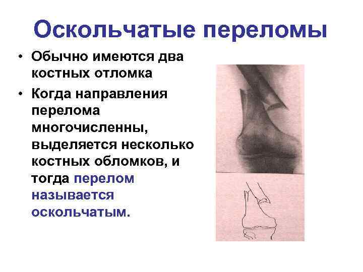 Оскольчатые переломы • Обычно имеются два костных отломка • Когда направления перелома многочисленны, выделяется