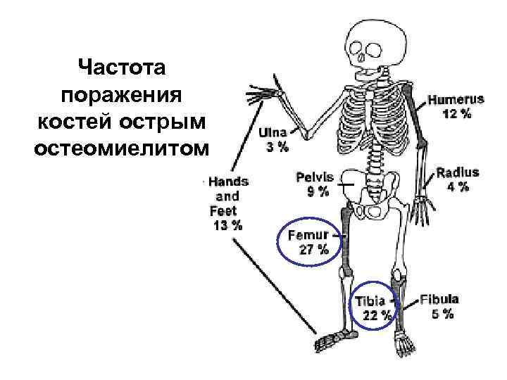 Частота поражения костей острым остеомиелитом 