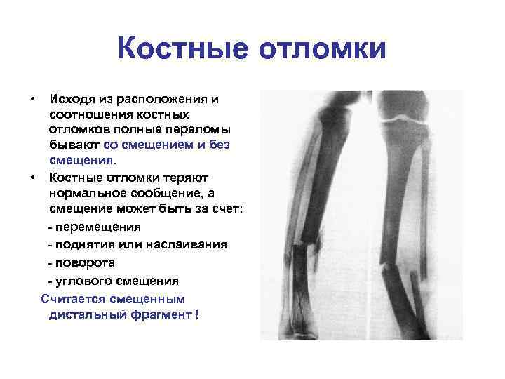 Костные отломки • Исходя из расположения и соотношения костных отломков полные переломы бывают со