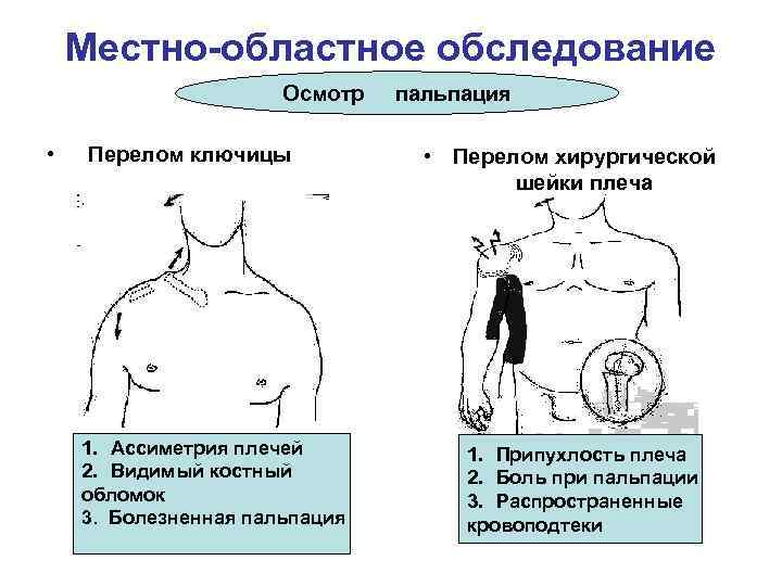 Местно-областное обследование Осмотр • Перелом ключицы 1. Ассиметрия плечей 2. Видимый костный обломок 3.