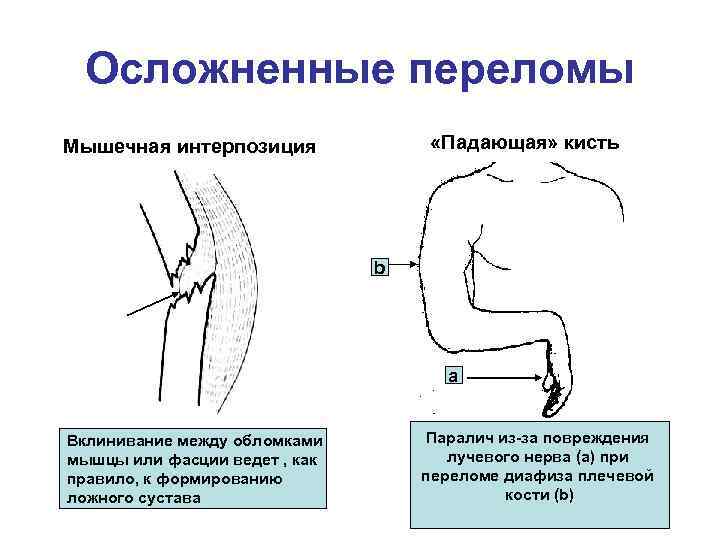Осложненные переломы «Падающая» кисть Мышечная интерпозиция b a Вклинивание между обломками мышцы или фасции