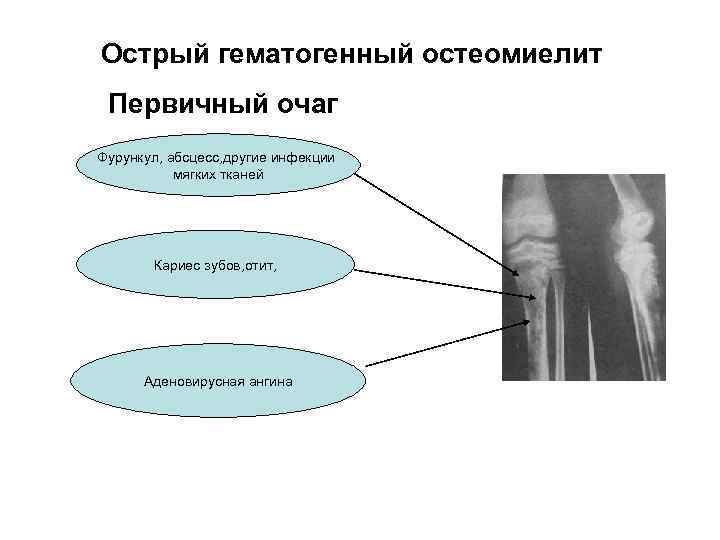 Признаки гематогенного остеомиелита