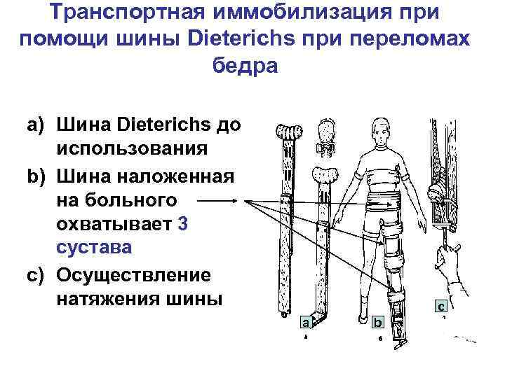Транспортная иммобилизация при помощи шины Dieterichs при переломах бедра a) Шина Dieterichs до использования