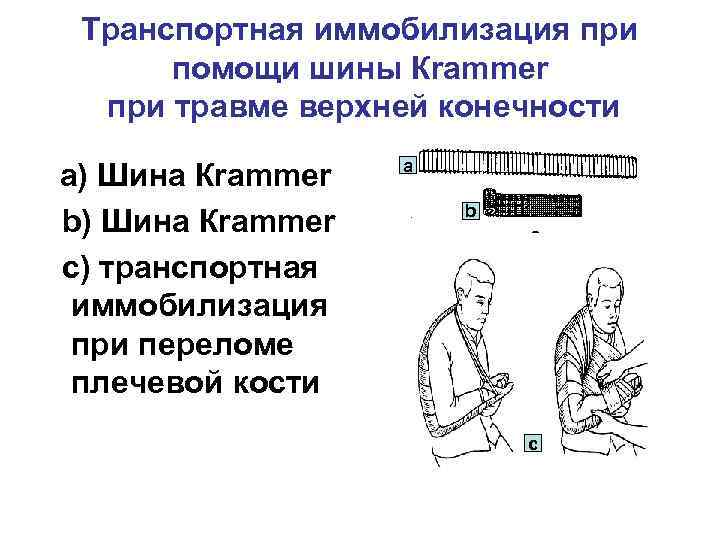 Транспортная иммобилизация при помощи шины Кrammer при травме верхней конечности a) Шина Кrammer b)