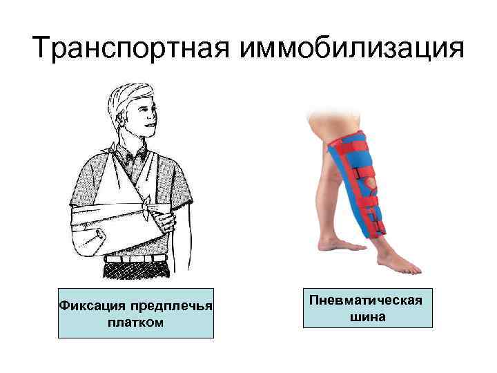 Транспортная иммобилизация Фиксация предплечья платком Пневматическая шина 