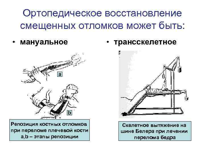 Открытая репозиция костных отломков