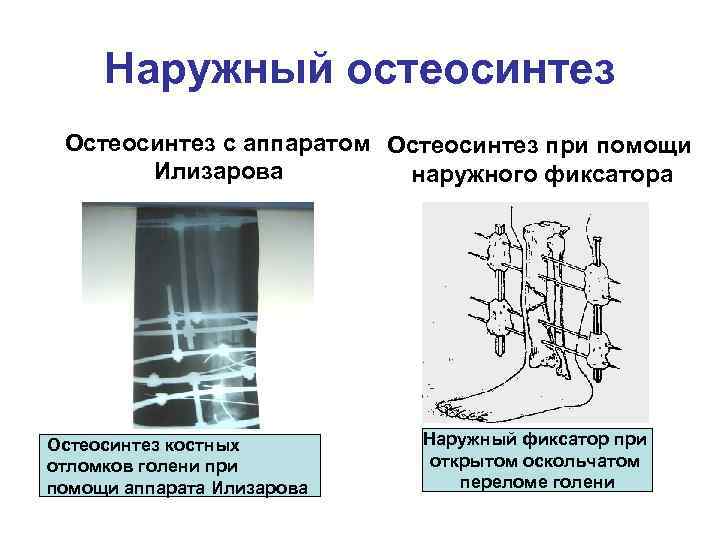 Ультразвуковой остеосинтез презентация