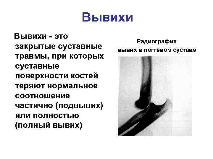Вывихи - это закрытые суставные травмы, при которых суставные поверхности костей теряют нормальное соотношение