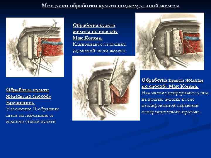 При туалете культи крупные сосуды для лигирования находят