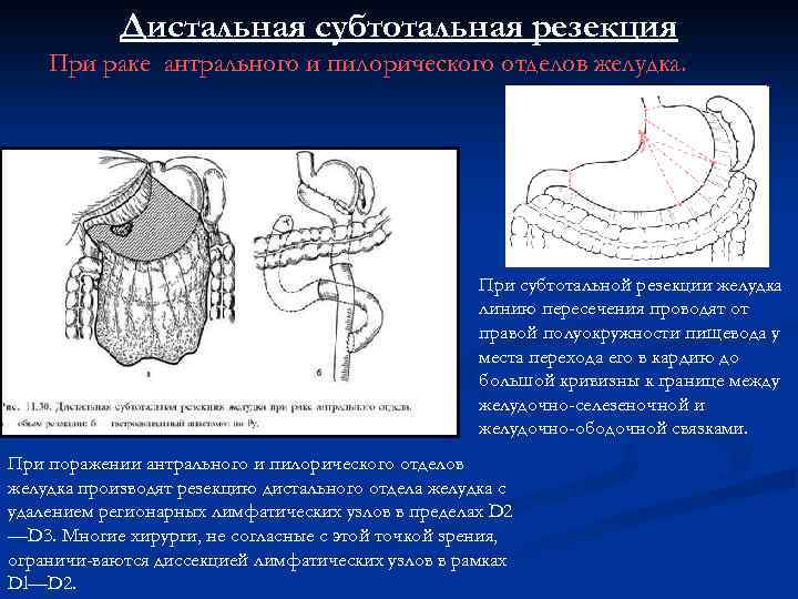 Рак желудка операция. Проксимальная субтотальная резекция желудка. Операции проксимальная резекция желудка. Дистальную субтотальную резекцию желудка. Ход операции проксимальная резекция желудка.