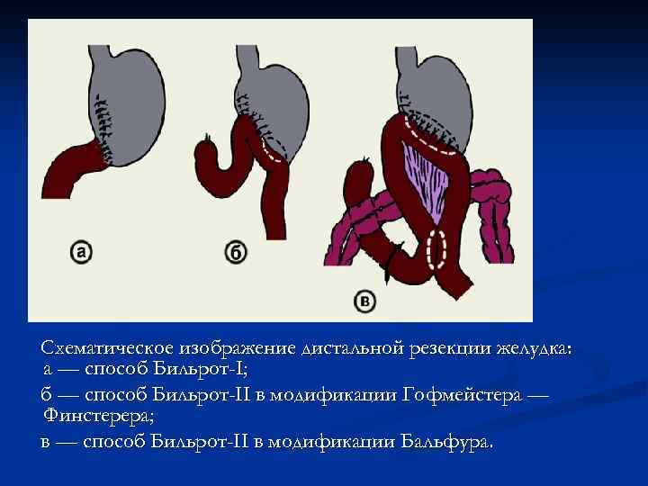 Резекция желудка по бальфуру схема