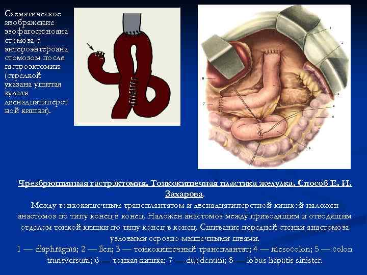Схематическое изображение эзофагоеюноана стомоза с энтероана стомозом после гастроэктомии (стрелкой указана ушитая культя двенадцатиперст