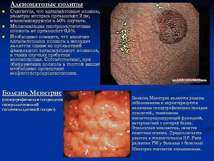 Аденоматозые полипы n n n Считается, что аденоматозные полипы, размеры которых превышают 2 см,