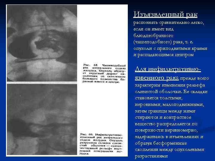 Изъязвленный рак распознать сравнительно легко, если он имеет вид блюдцеобразного (чашеподобного) рака, т. е.