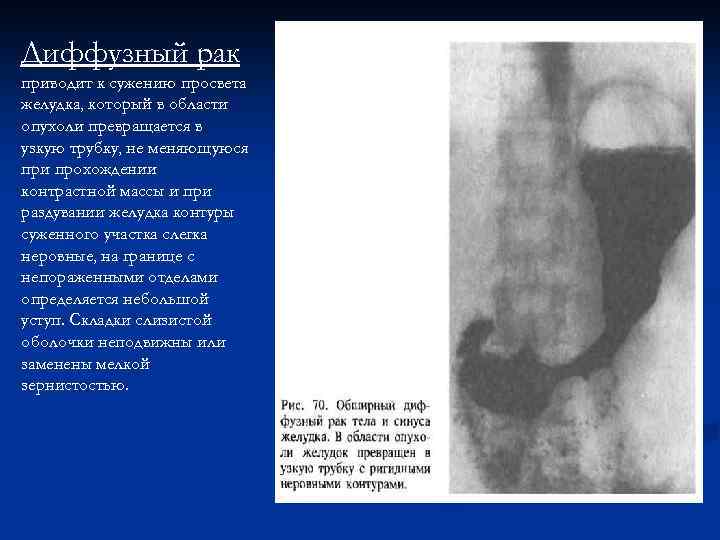 Диффузный рак приводит к сужению просвета желудка, который в области опухоли превращается в узкую