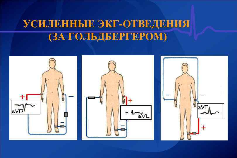 УСИЛЕННЫЕ ЭКГ-ОТВЕДЕНИЯ (ЗА ГОЛЬДБЕРГЕРОМ) + 