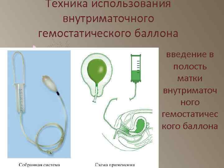 Техника использования внутриматочного гемостатического баллона введение в полость матки внутриматоч ного гемостатичес кого баллона