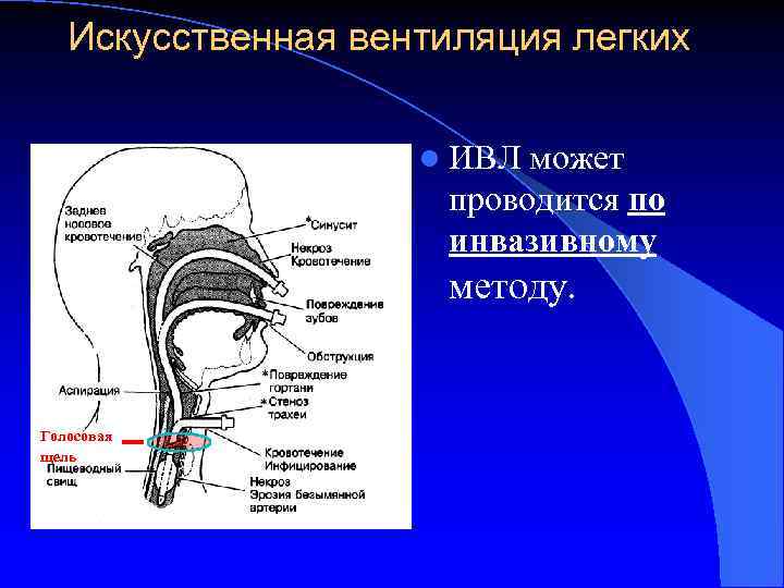 Искусственная вентиляция легких l ИВЛ может проводится по инвазивному методу. Голосовая щель 