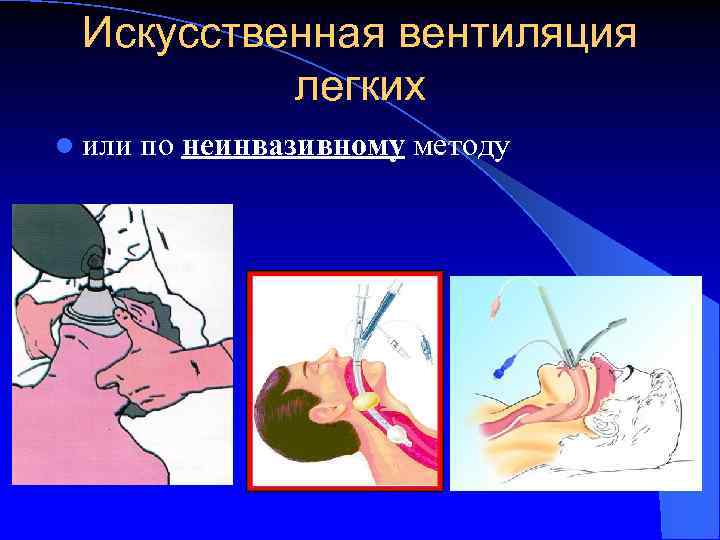 Искусственная вентиляция легких l или по неинвазивному методу 