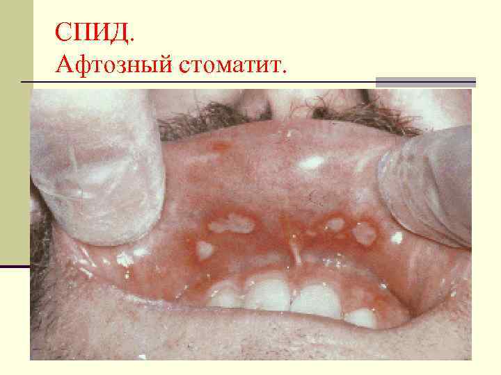 СПИД. Афтозный стоматит. 