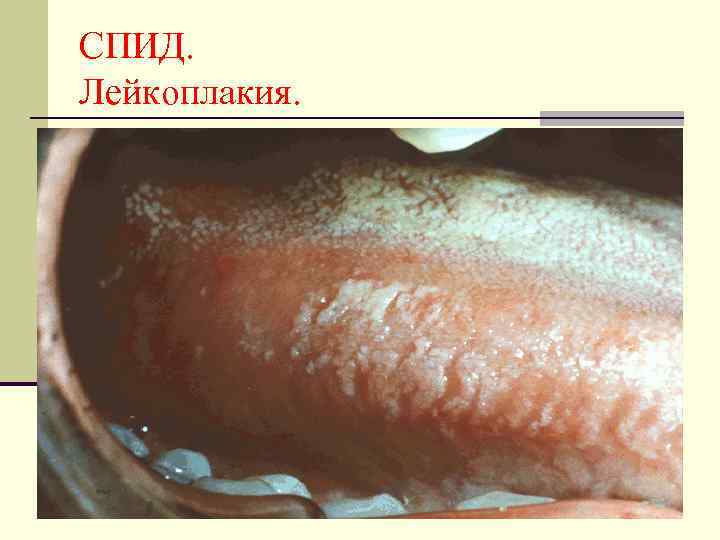 СПИД. Лейкоплакия. 
