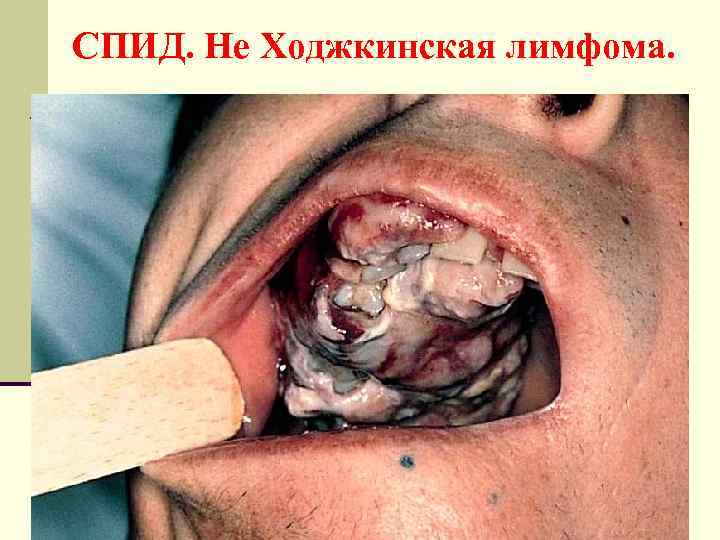 СПИД. Не Ходжкинская лимфома. 