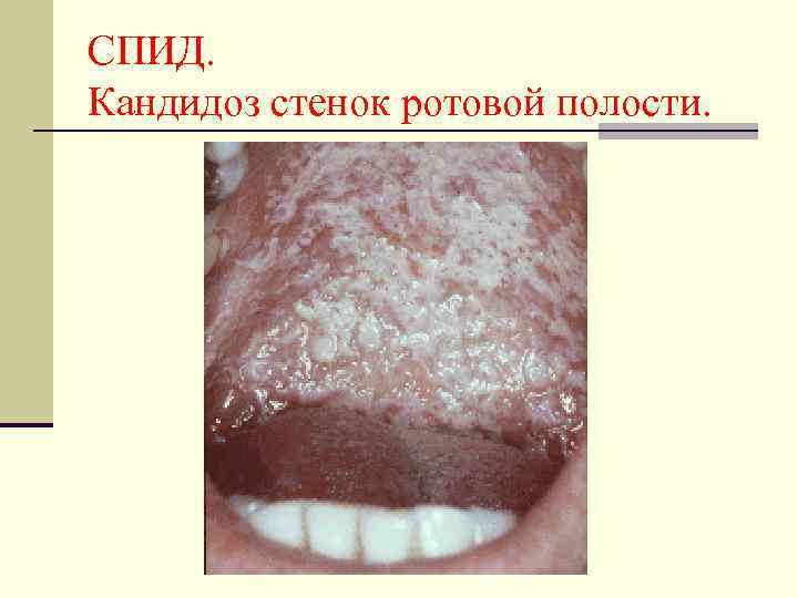 СПИД. Кандидоз стенок ротовой полости. 